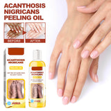 Acanthosis Nigricans peeling oil with packaging and before/after effects on hands.