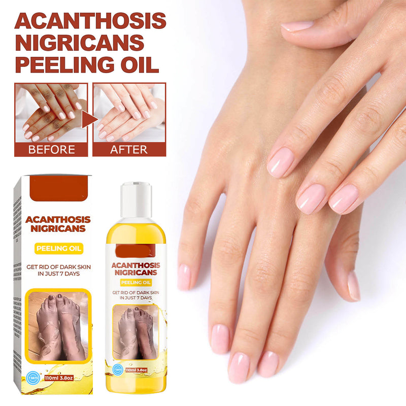 Acanthosis Nigricans peeling oil with packaging and before/after effects on hands.